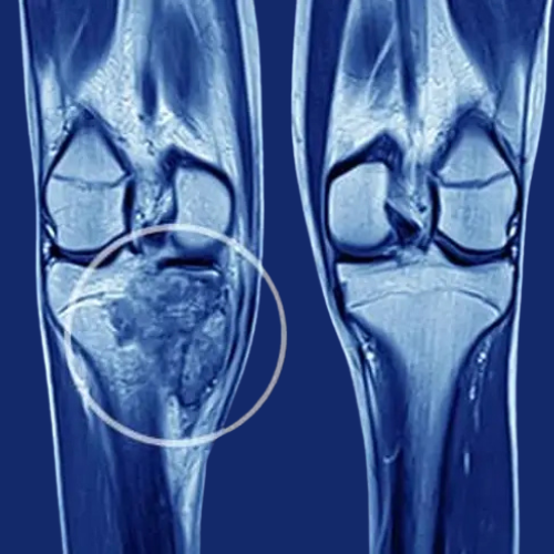 Tumor-Surgery