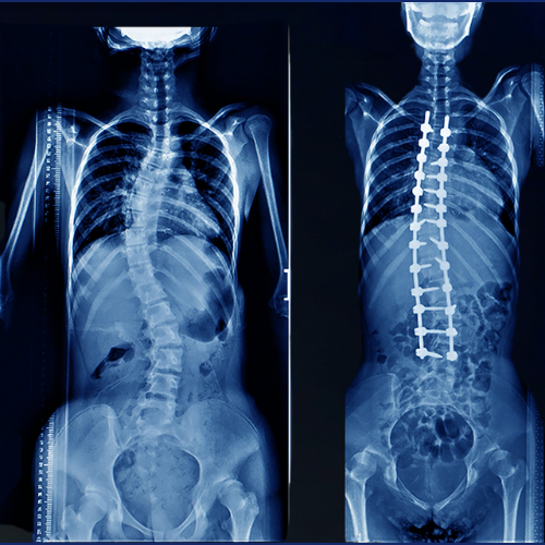 scolisis-surgery