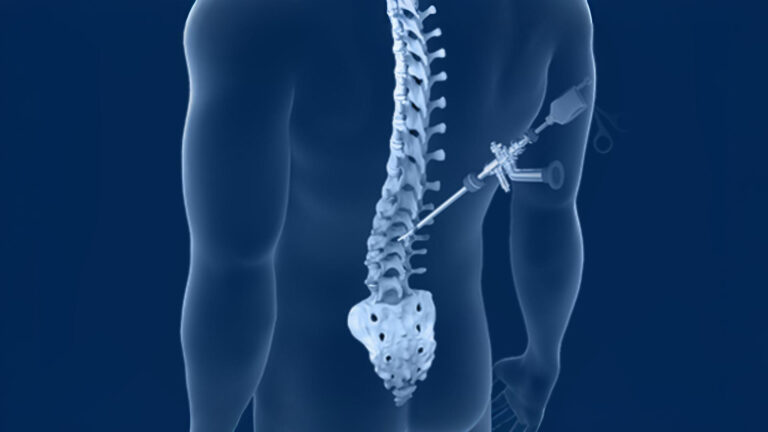 Endoscopic spine surgery treatment by spine specialist in Noida