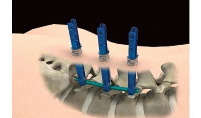 Minimally invasive spine surgery treatment by specialist in Noida