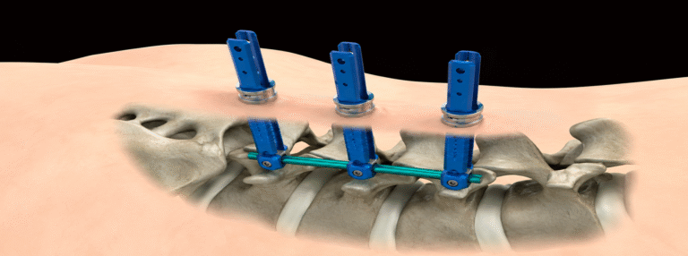 Dr. Rajesh Mishra || Minimally invasive spine surgery treatment