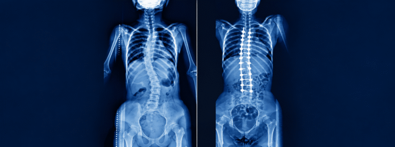 Dr. Rajesh Mishra || Scoliosis and spinal deformity correction surgery || treatment.