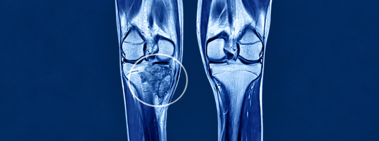 Dr. Rajesh Mishra || Spine and bone tumour surgery || treatment.